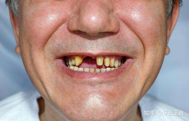 这个新型无挂钩义齿,哪些人适合做?医生的建议很有用!