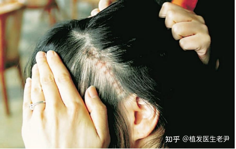 疤痕处可以植发吗? - 知乎