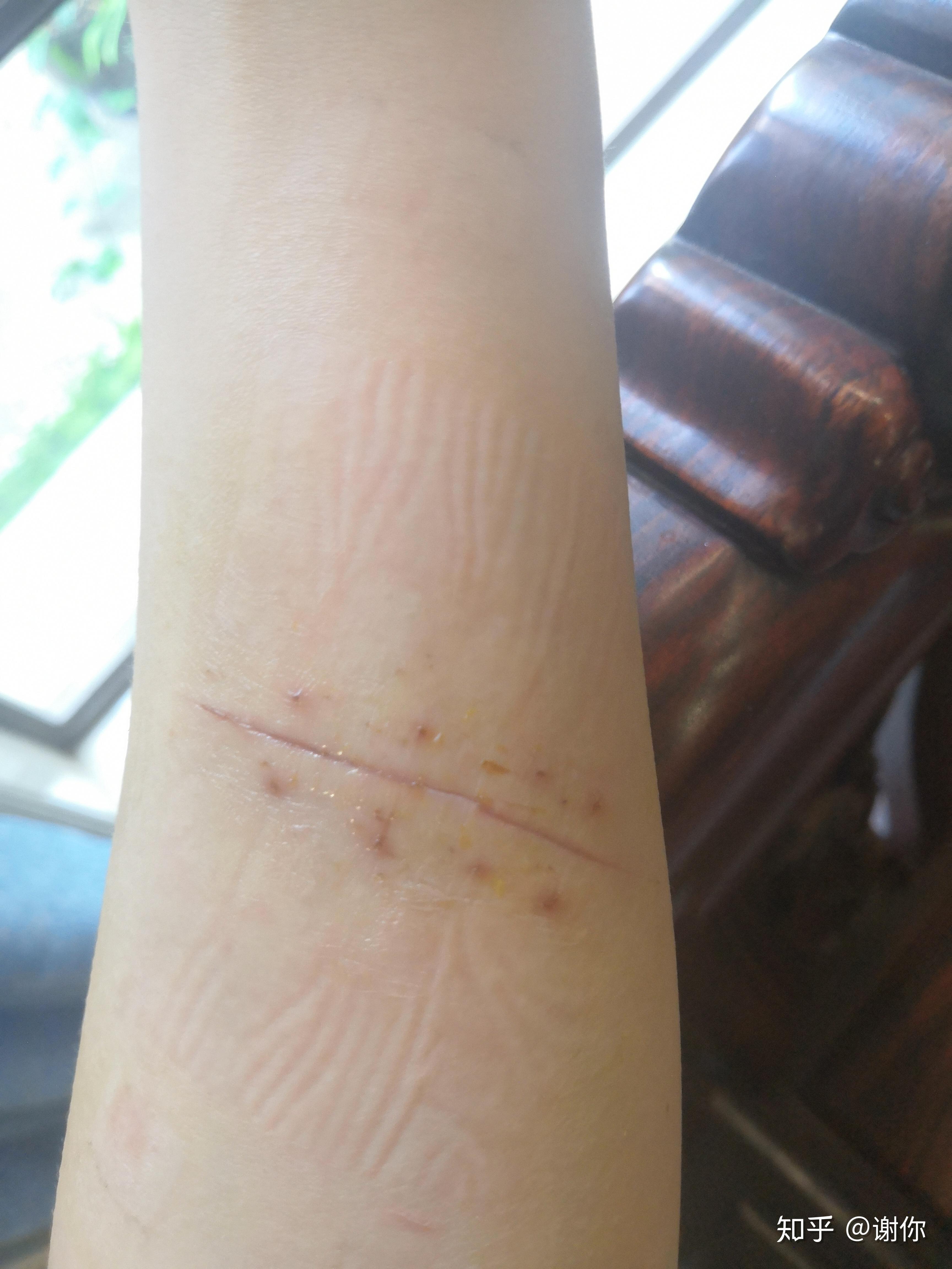 手臂刀割伤疤痕预防修复打卡记录