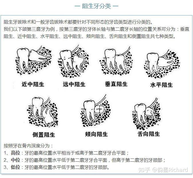 阻生牙的分类图片图片