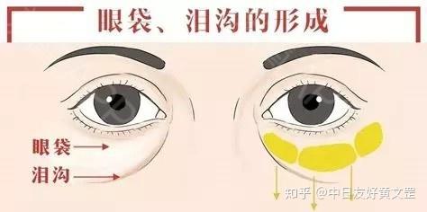 有了泪沟太显老?3种方法教你摆平泪沟 - 知乎