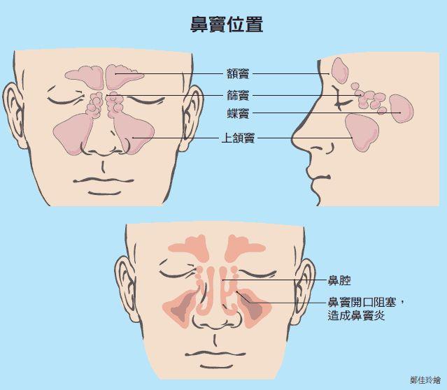 鼻渊和鼻鼽区别 zhuanlan.zhihu.com