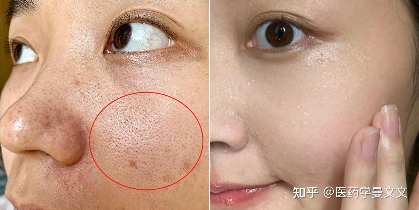 (缩小毛孔请进)脸上毛孔粗大怎么改善?皮肤摸着像沙子一样特粗糙,毛孔又大又密,【皮肤科医生】教你1招收缩毛孔方法,抢救毛孔粗大、细腻光滑皮肤看 ...