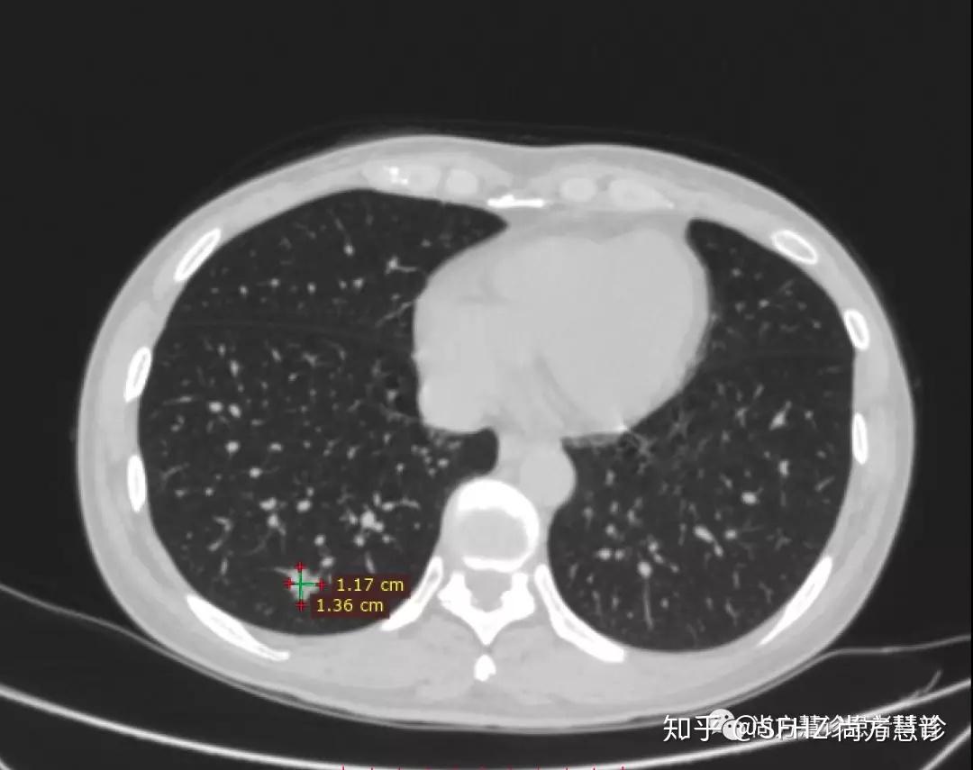 影像学检查中显示的肺部“小结节”，意味着什么? - 知乎