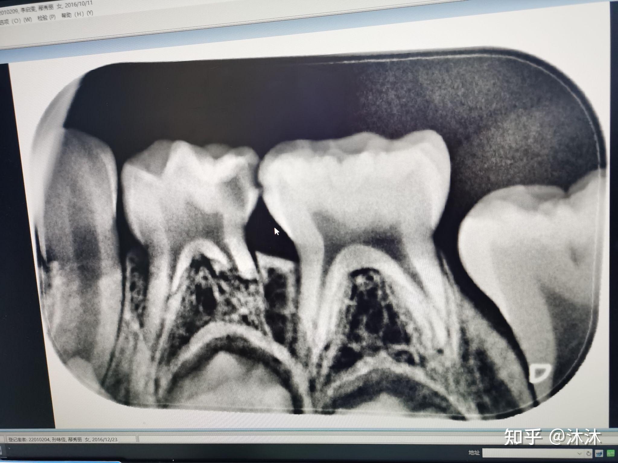 【附图】 牙体解剖：前牙、前磨牙、磨牙 _口腔医学 | 天山医学院