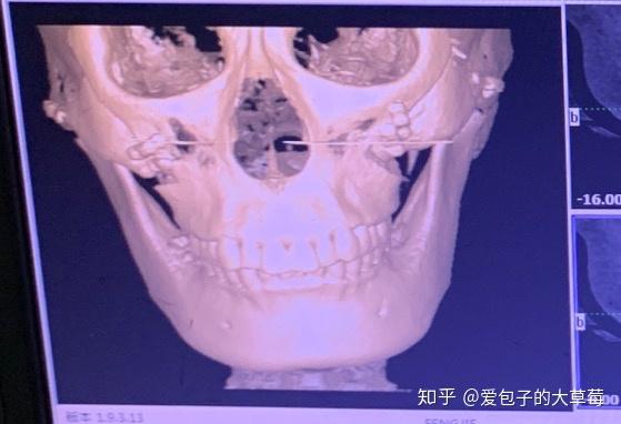 面部轮廓固定怎么做_面部轮廓固定用什么材料_轮廓面部固定做多少钱