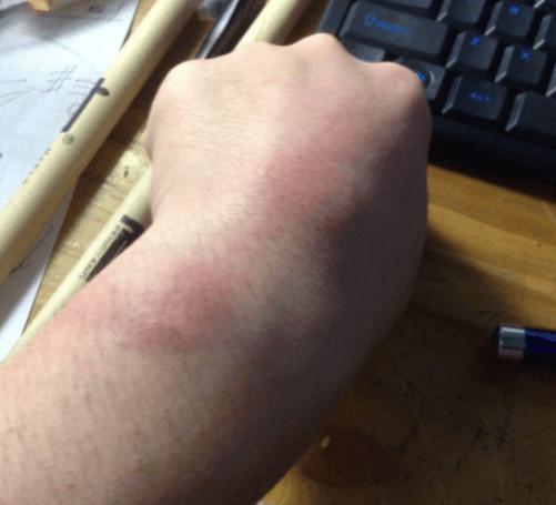 得了荨麻疹怎么办用兰幼皮肤抑菌霜2个疗程彻底治愈不复发