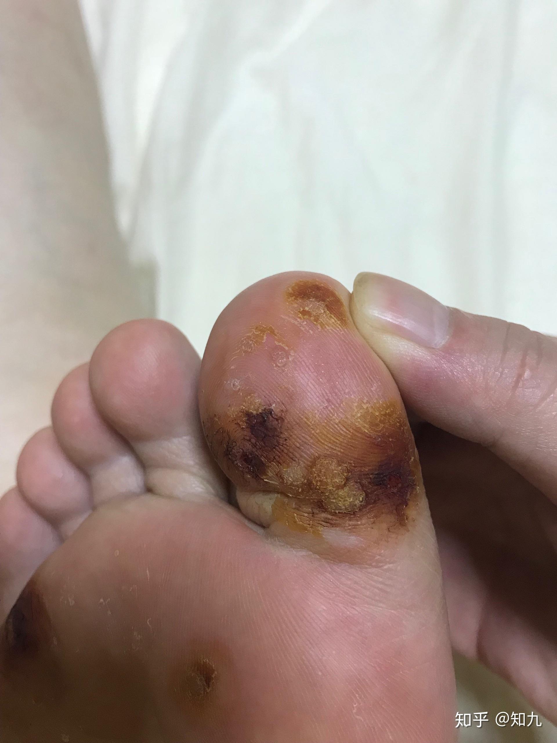 跖疣真的可以自愈的大家不要去浪费钱了