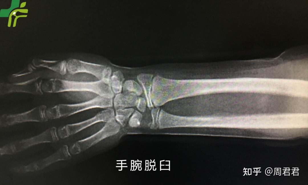 三口骨科三口伯伯说骨事手腕脱臼你知多少