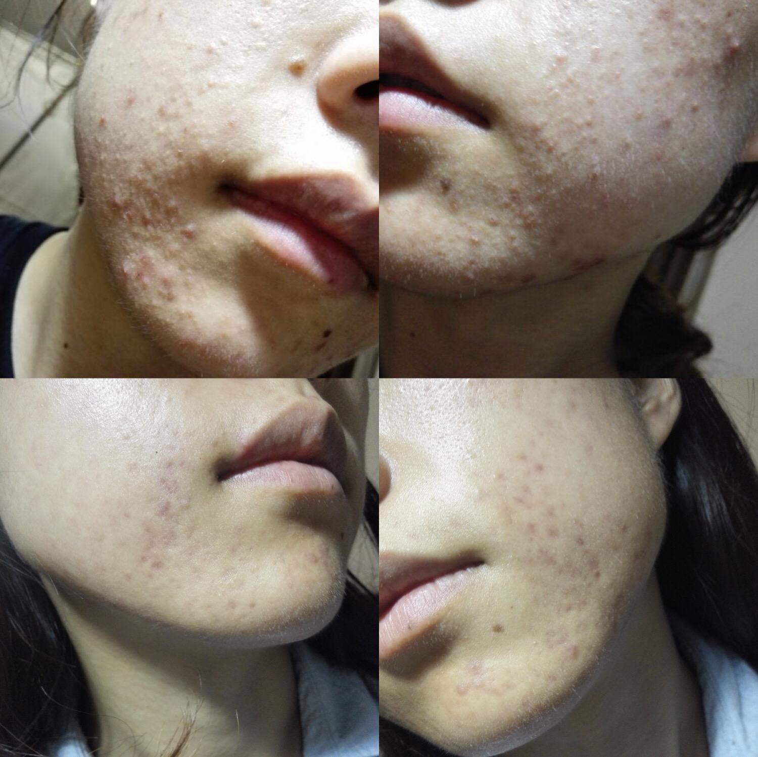 补水时痘痘会越来越多吗开口闭口型粉刺怎么办