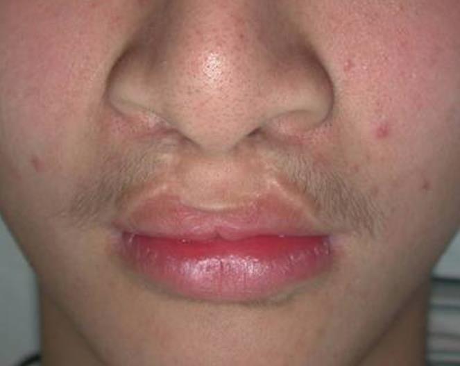 成年后兔唇还能修复吗