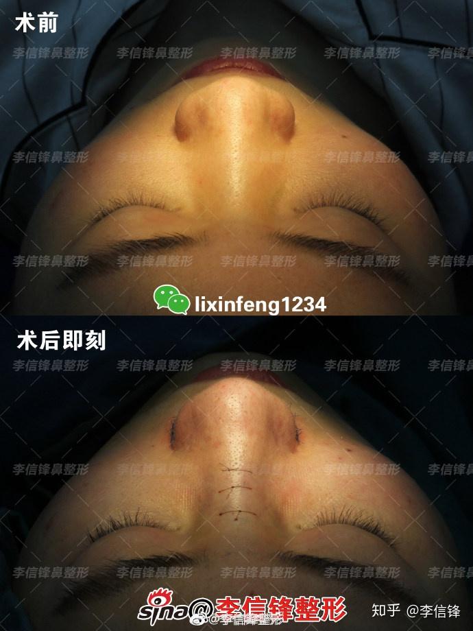 李信锋鼻整形宽鼻缩窄鼻骨内推