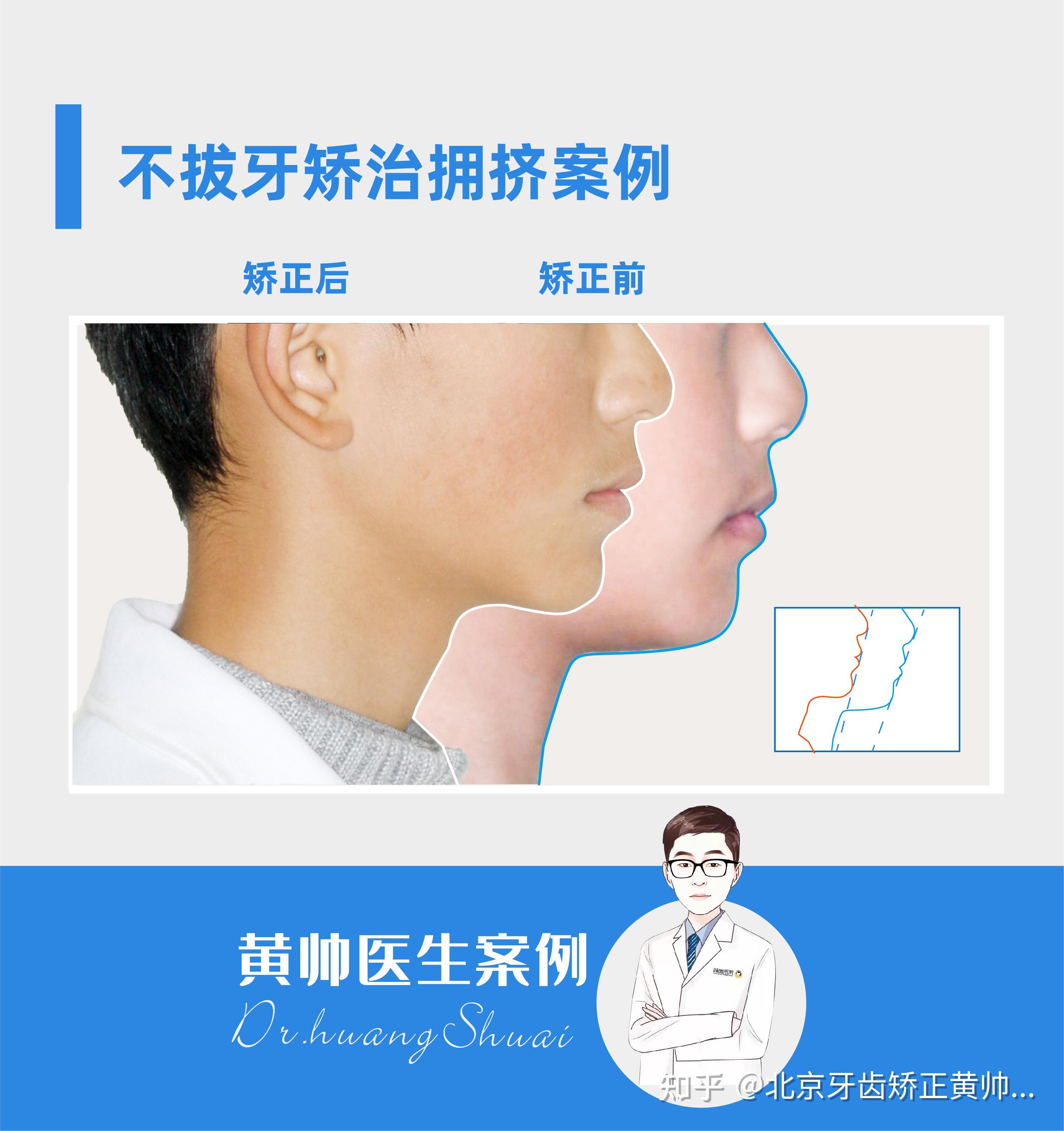 矫治完成后上下颌牙齿排齐,咬合关系正常,牙弓宽度恢复正常,依然保持