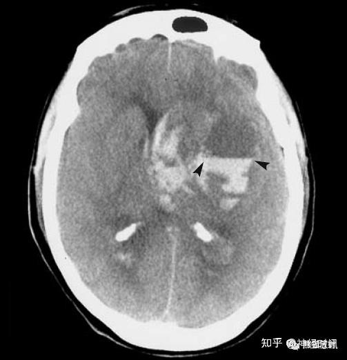 腦實質內出血丨演變分佈ct表現