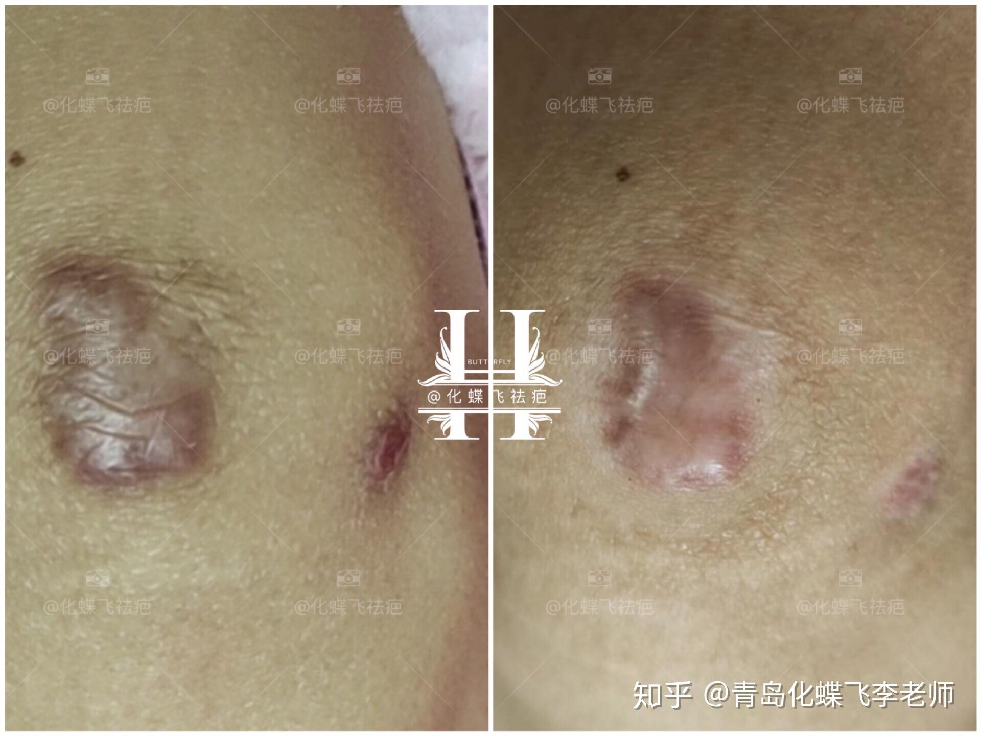 代谢一次,小的增生已经全部平了,大的增生疤痕,颜色淡化了,疤痕缩小了