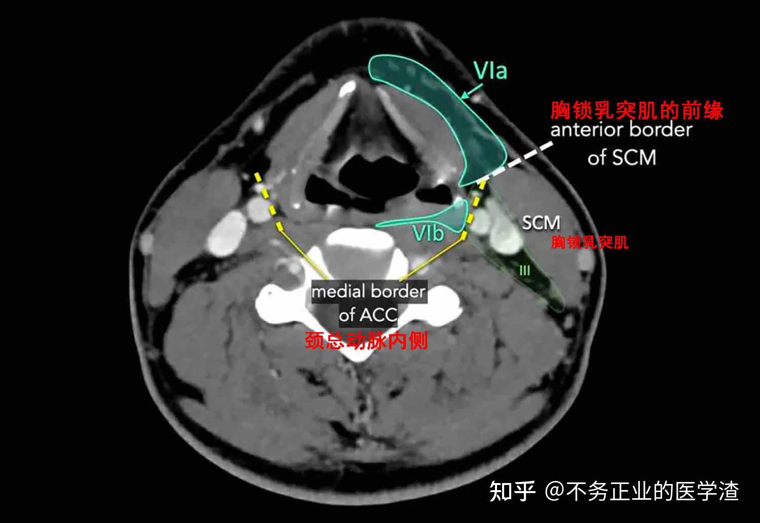 内乳淋巴结ct片图解图片