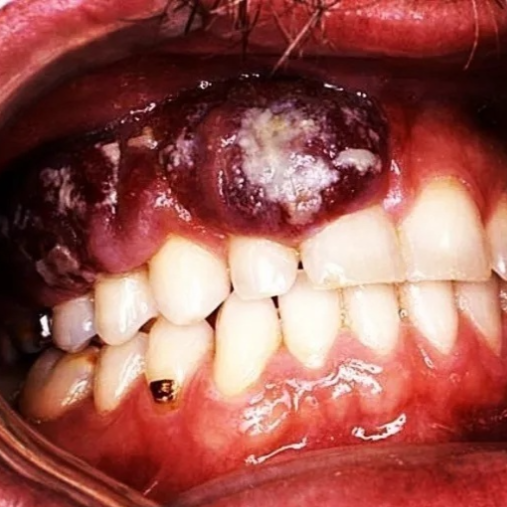 感染hiv病毒早期的时候,患者口腔中会出现卡波西肉瘤