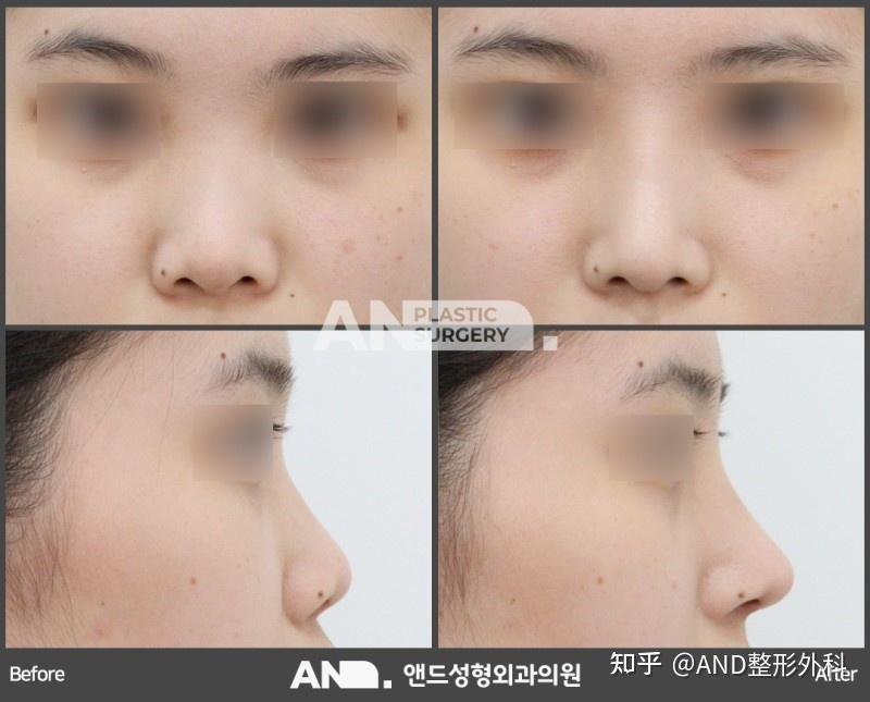 无立体感的低鼻梁、单纯鼻梁+鼻尖手术就能改善吗? / 江南低鼻手术/人中整形 - 知乎