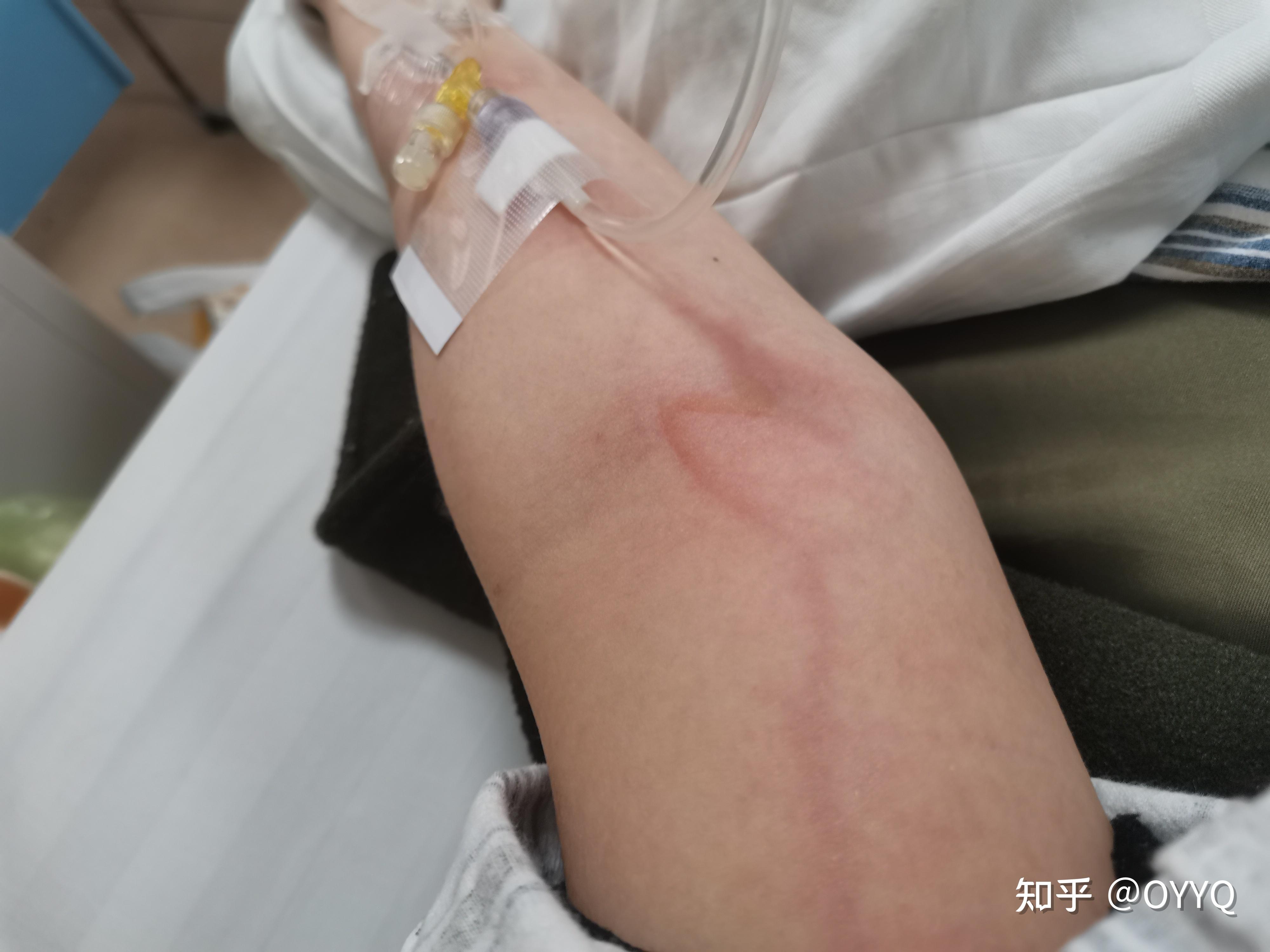 剂第二天做气管镜2021年3月皮试手上皮试应该是强阳性的,肿了很大一块