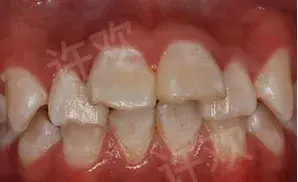 什么是牙齿脱矿?戴个牙套怎么还把牙戴脱矿了 - 知乎