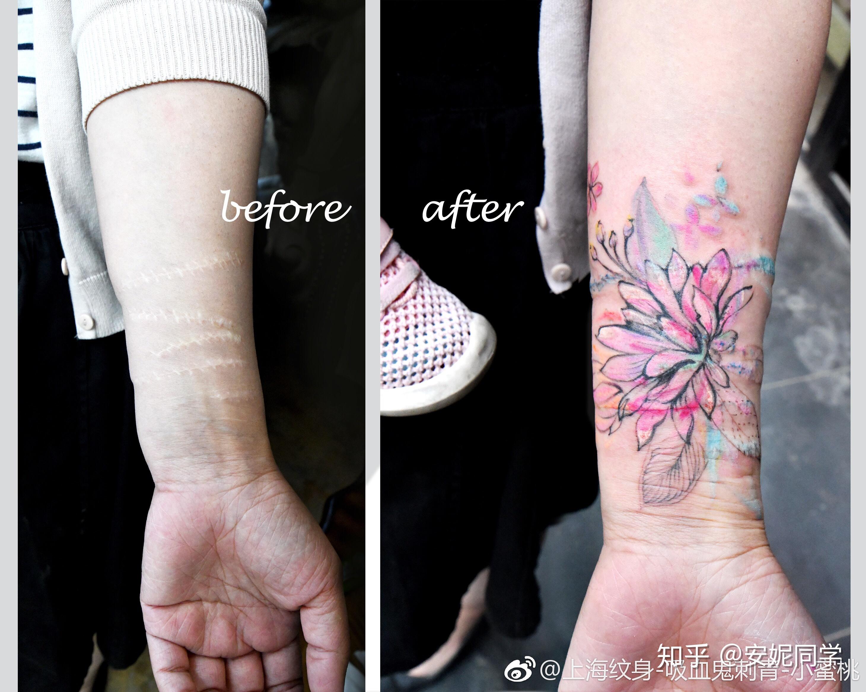 米奇纹身（烟疤遮盖）&手术疤纹身遮盖 #刺青师大龙#_DragonTattoo大龙-站酷ZCOOL