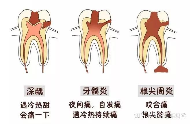 科普虫牙真是牙齿被虫子吃了吗