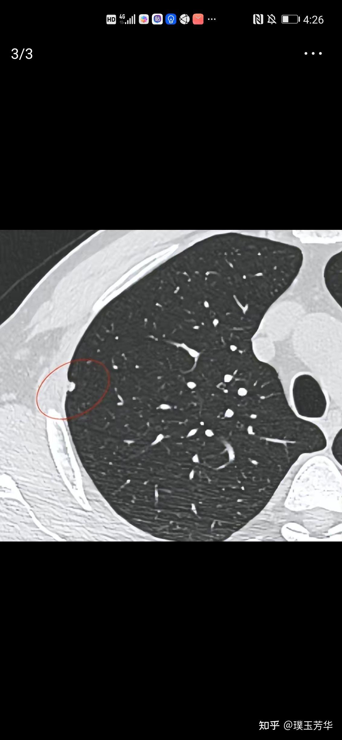 无危险的磨玻璃肺结节不长大2mm不着急手术,那长大了2mm呢?