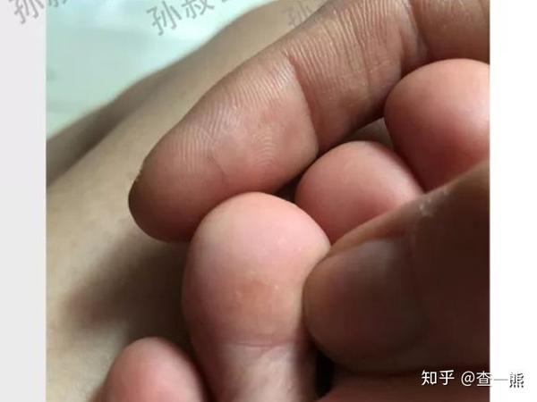 蹠疣篇你還記得原來的蹠疣在什麼位置嗎