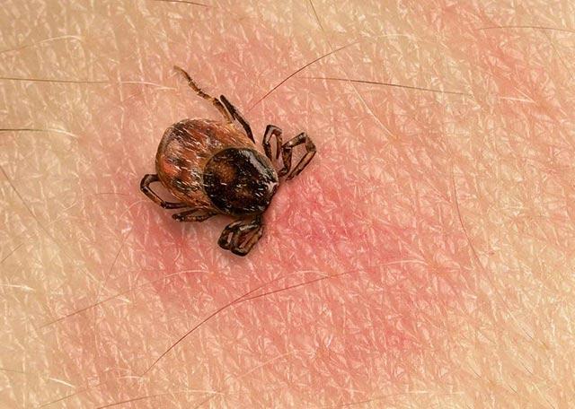 蜱虫叮咬的症状以及被蜱虫叮咬怎么处理