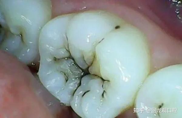 回龙观口腔医院荷马口腔龋齿蛀牙治疗方法