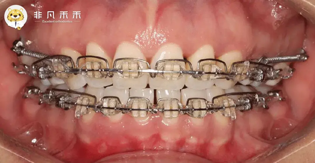 正畸病例牙不齐不拔牙矫治病例一例