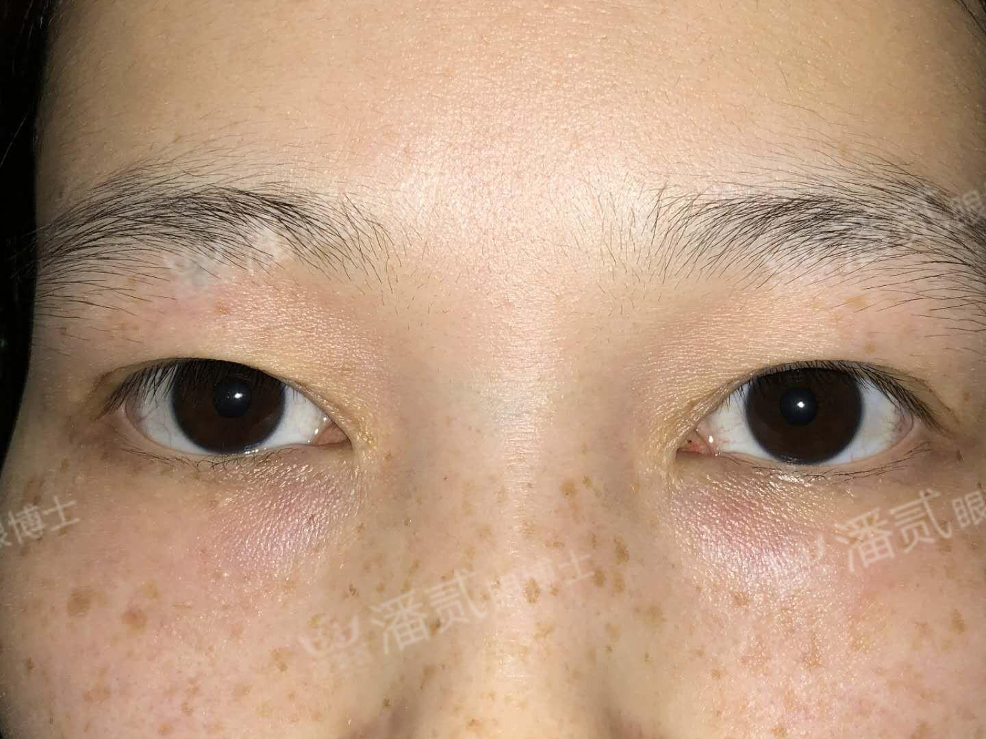 14年割的双眼皮，开内眼角手术失败，疤_新氧-专业医美服务平台