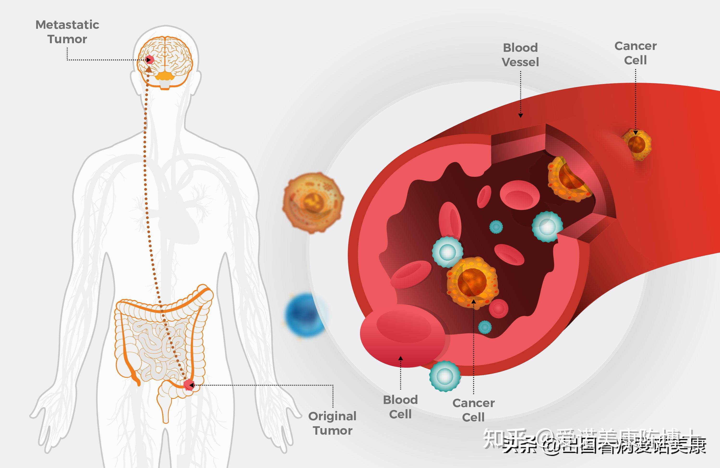 metastatic-cancer-kya-hai-what-is-metastatic-cancer-in-hindi