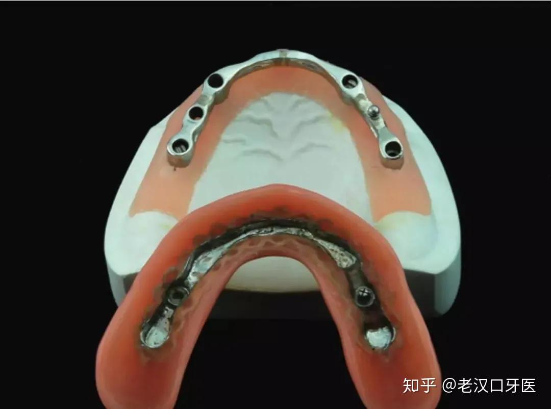武汉存济种植牙知识大全,建议收藏 - 知乎