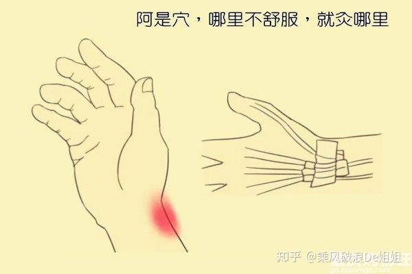 啊……是这里!阿是穴就是这么来的