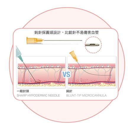 吴志贤医生||注射玻尿酸,该选钝针还是锐针? - 知乎