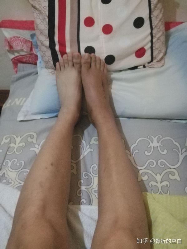 脚骨折后的生无可恋记录贴