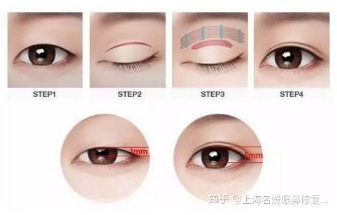 双眼皮全切和埋线哪个比较好