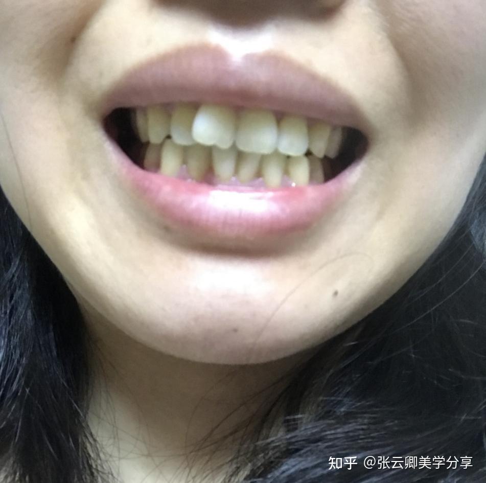 本身嘴巴就凸,还可以去丰唇吗? - 知乎
