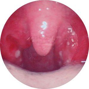 首大李艳华 扁桃体炎与喉咙痛有哪些区别 知乎