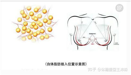 自體脂肪豐胸後多久可以消腫