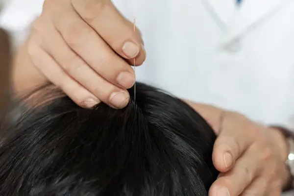 针灸一针见效但请勿自学针灸