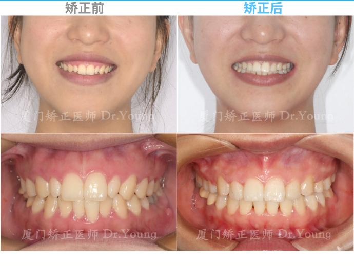 厦门牙齿矫正骨性ii类高角上颌前突下颌后缩案例分享