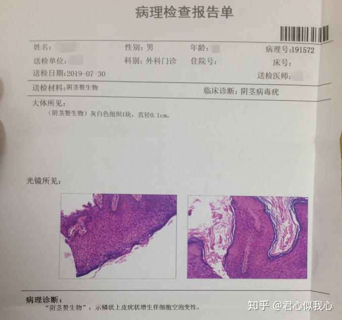 分享治疗尖锐湿疣的痛苦和经历