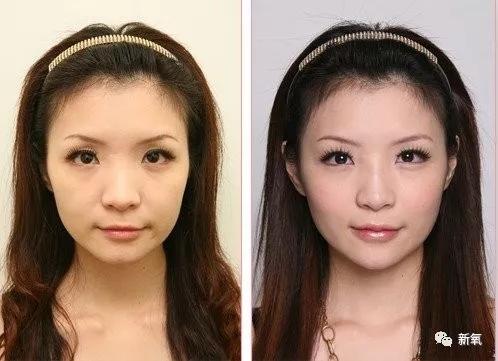 为什么做个双眼皮还能后天长出卧蚕