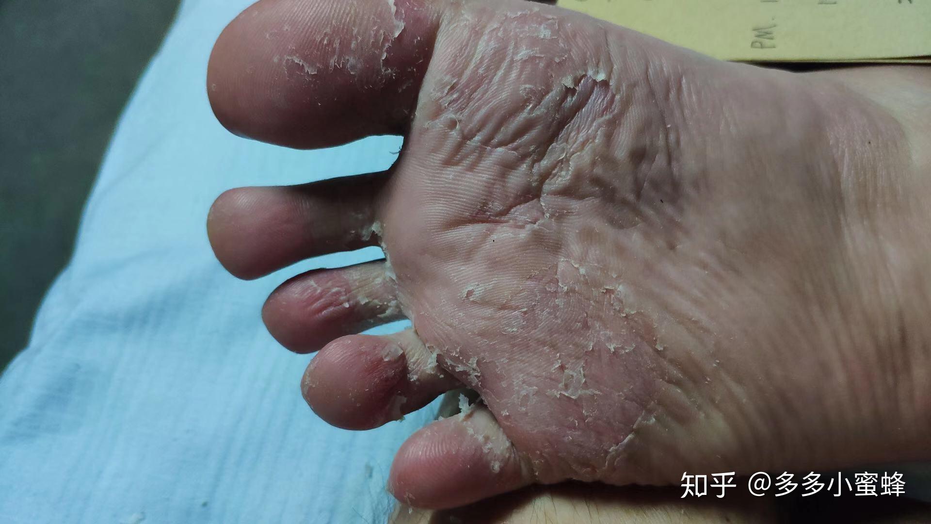 脚脱皮是什么原因