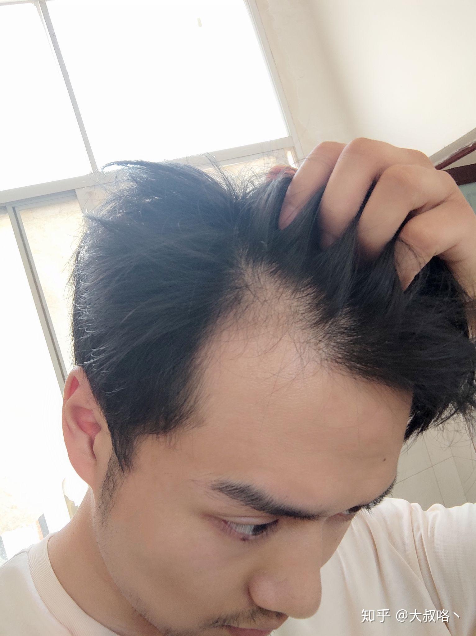 422今天开始记录脱发少年使用米诺地尔酊和非那雄胺片的变化持续更新