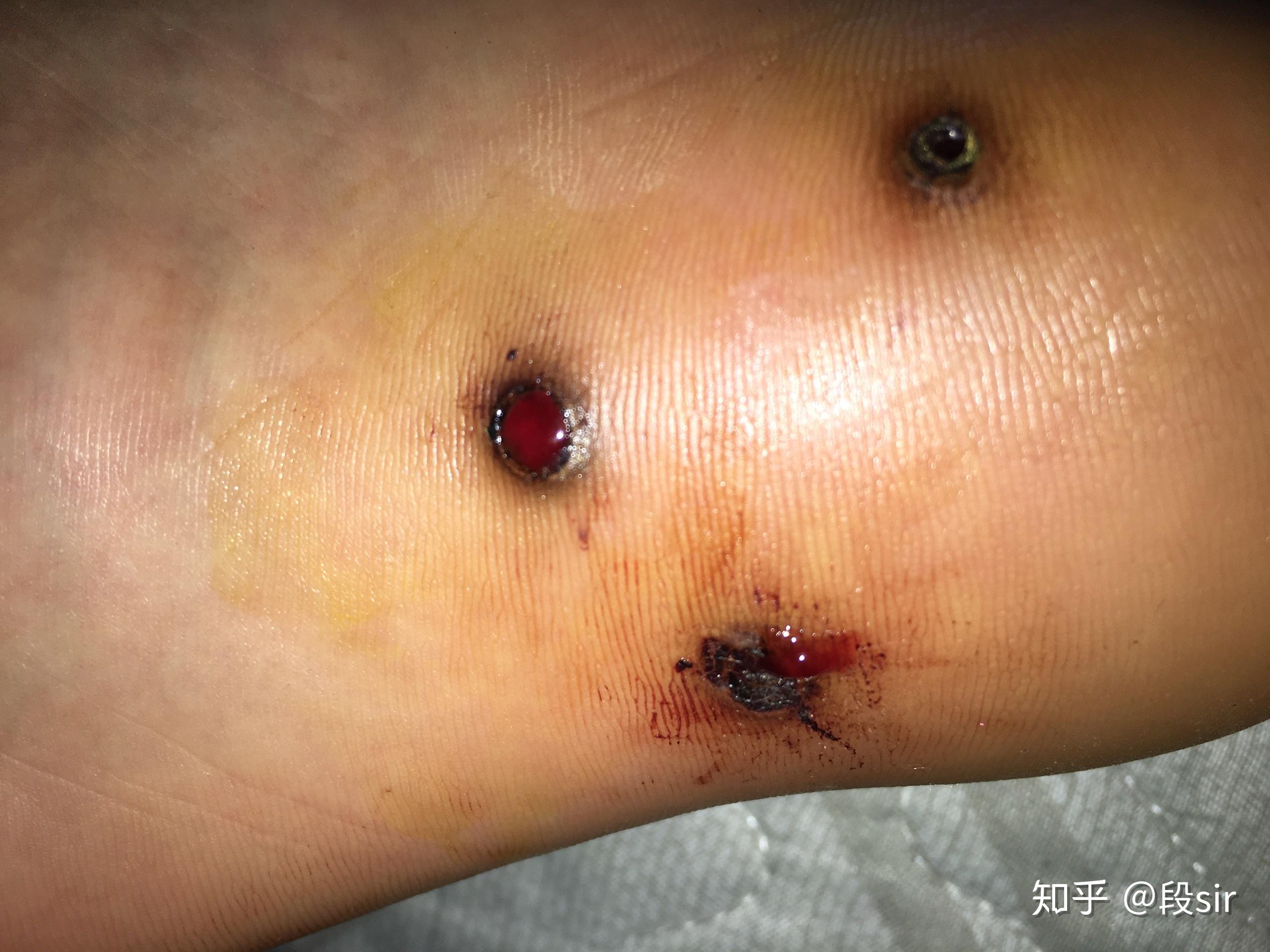 跖疣用激光的过程