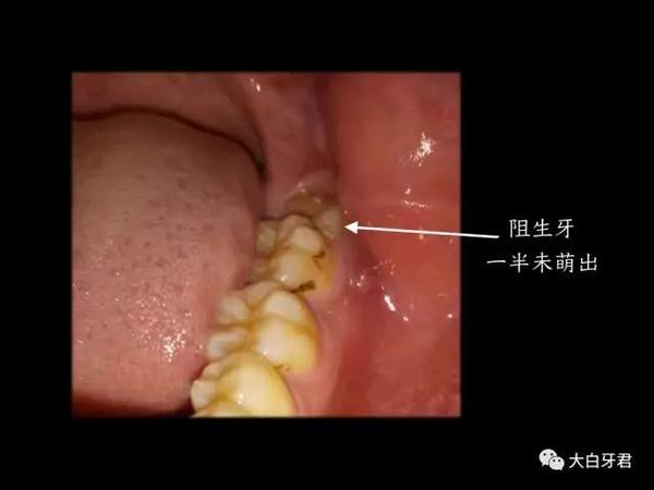 智齿不痛就不用拔吗 看了这篇你就懂了 知乎