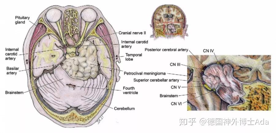 两种手术方式,具体上多种手术入路可用于岩斜区病变切除,如岩骨前入路